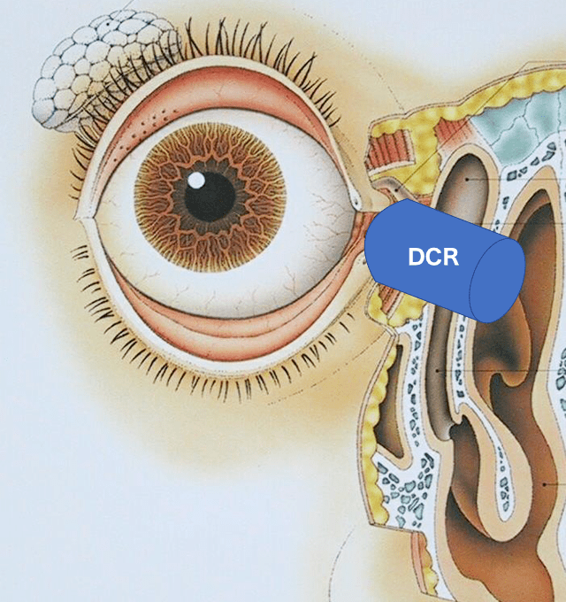 DCR